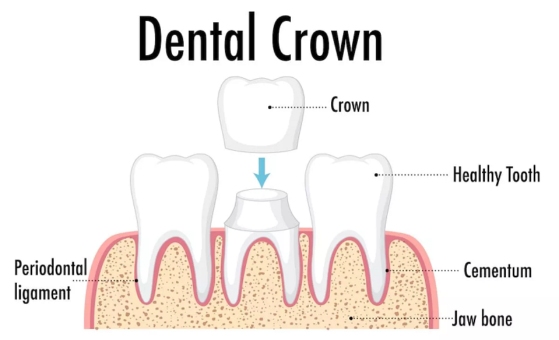 "Diagram of Dental Crown Treatment at Dr. JJ Multispeciality Clinic, Bhopal"